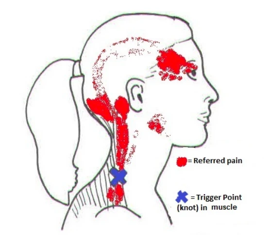 Migraines and Neck Pain: Finding Relief through Chiropractic Care