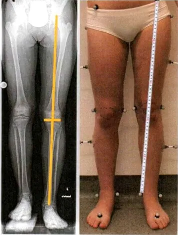 Child with a mild leg length difference, assessed by a Boston chiropractor