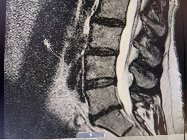 Why does the table angle matter in spinal decompression and why most clinics are basically guessing